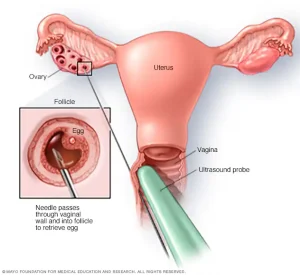 Egg Freezing